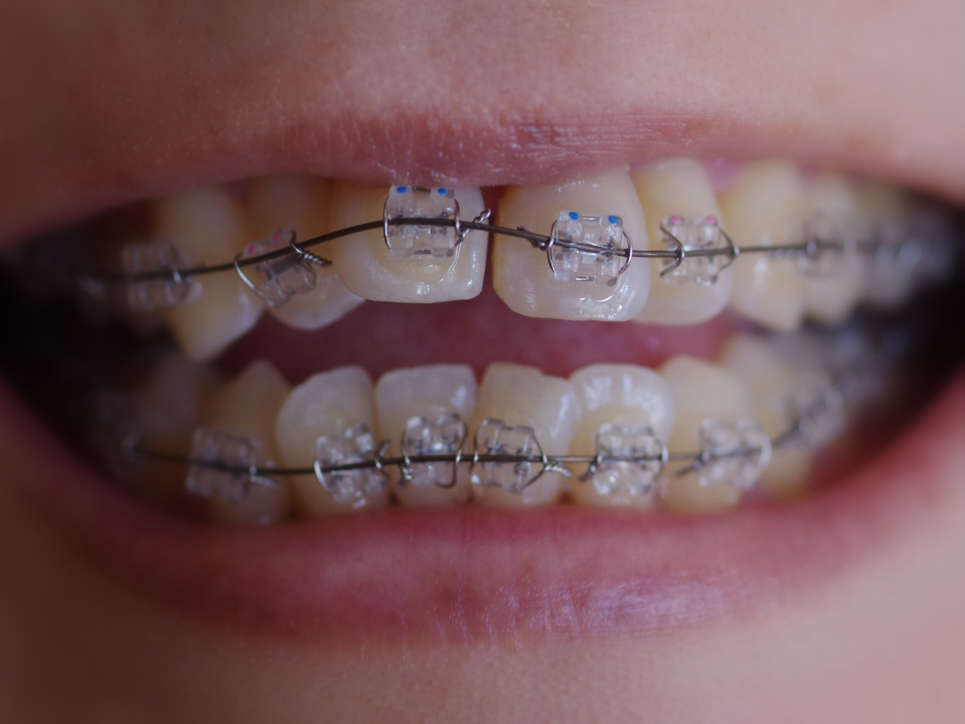 Metal and ceramic braces for all ages at The Tooth Place Hubli
