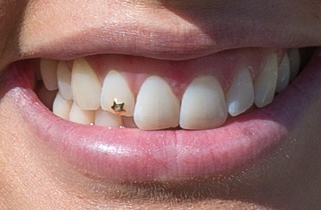 Cosmetic tooth gems and jewelry at The Tooth Place Hubli